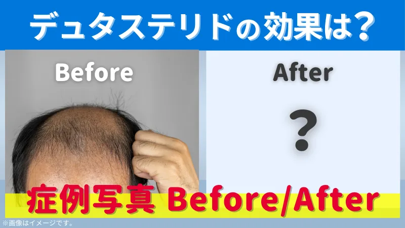 デュタステリドの効果-症例写真ビフォーアフター