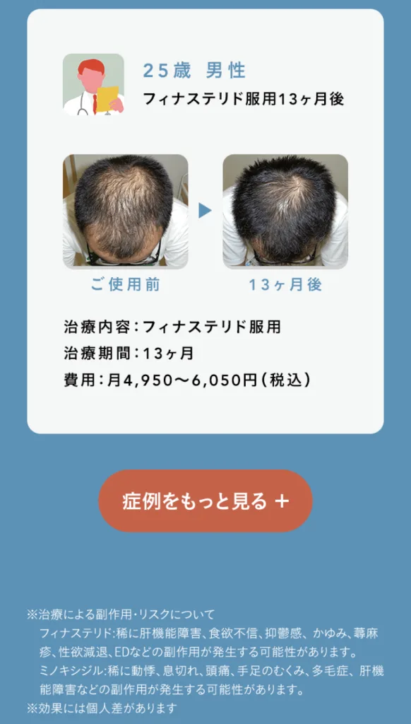 OopsHAIR-フィナステリド-症例写真ビフォーアフター