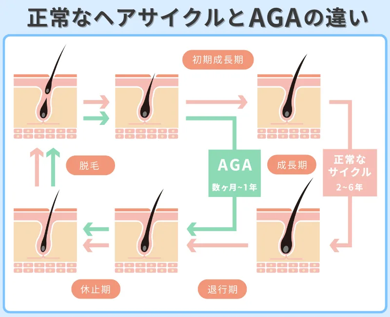 正常なヘアサイクル-AGAのヘアサイクル-違い