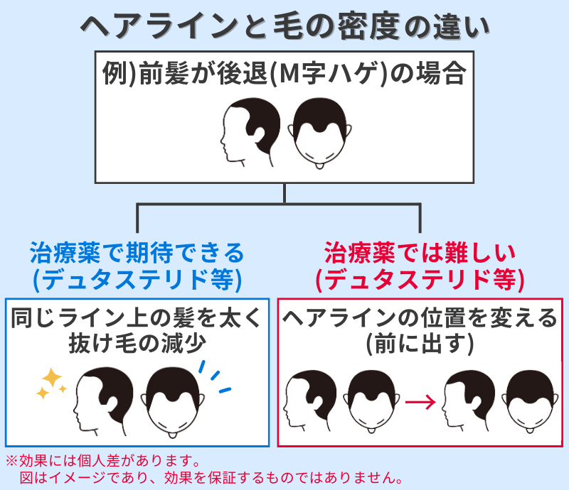 デュタステリドによるヘアラインと毛の密度の違い