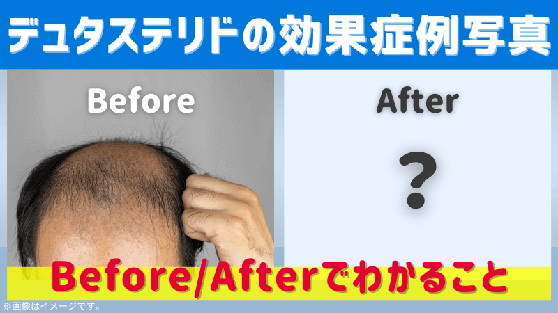 デュタステリドの効果症例写真のアイキャッチ